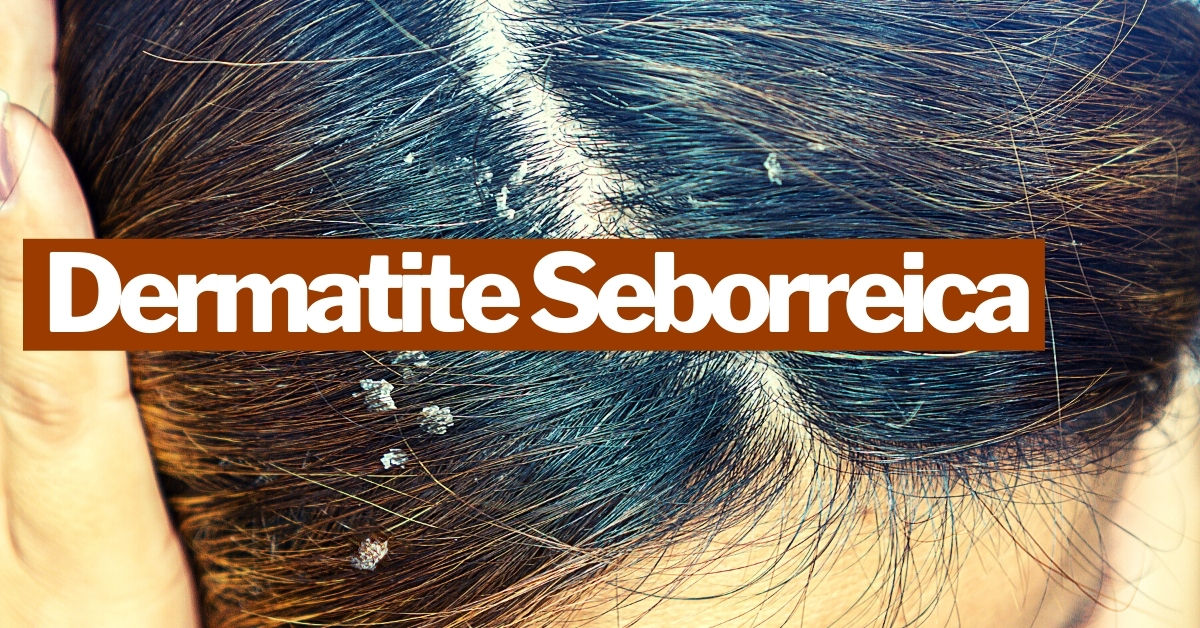 Dermatite Seborreica: causas e sintomas