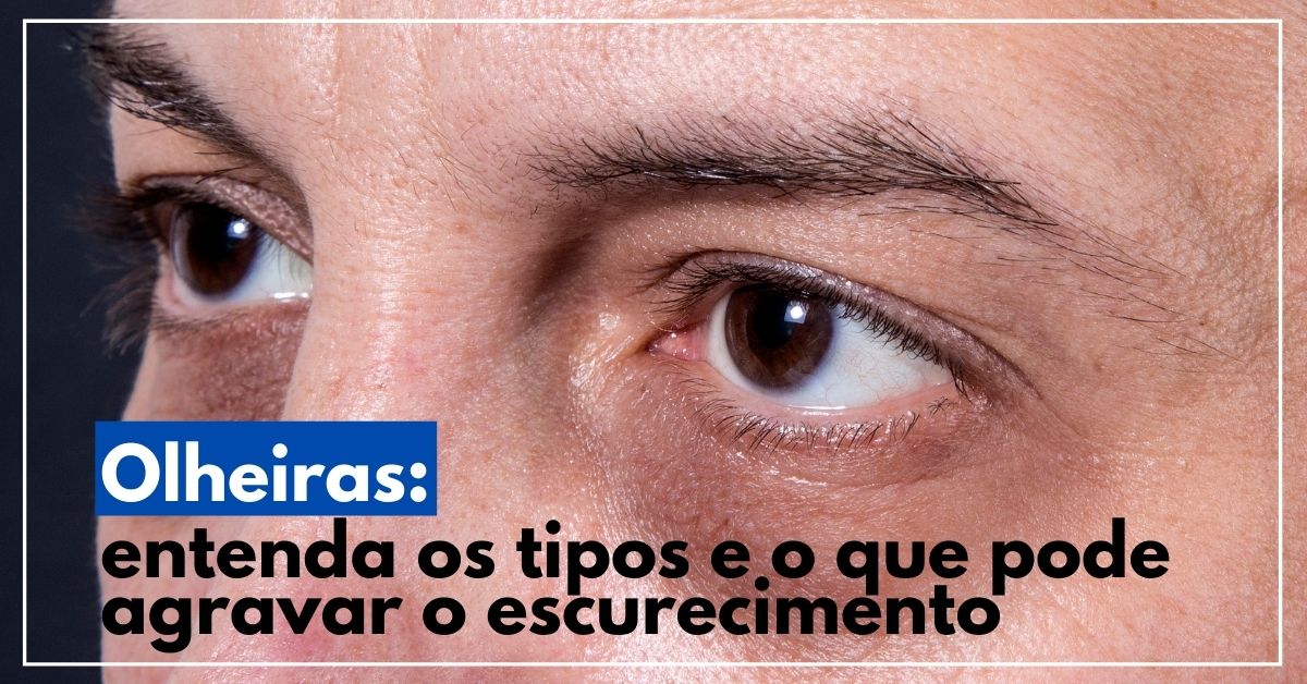 Ojeras: conoce los tipos y qué puede agravarlas