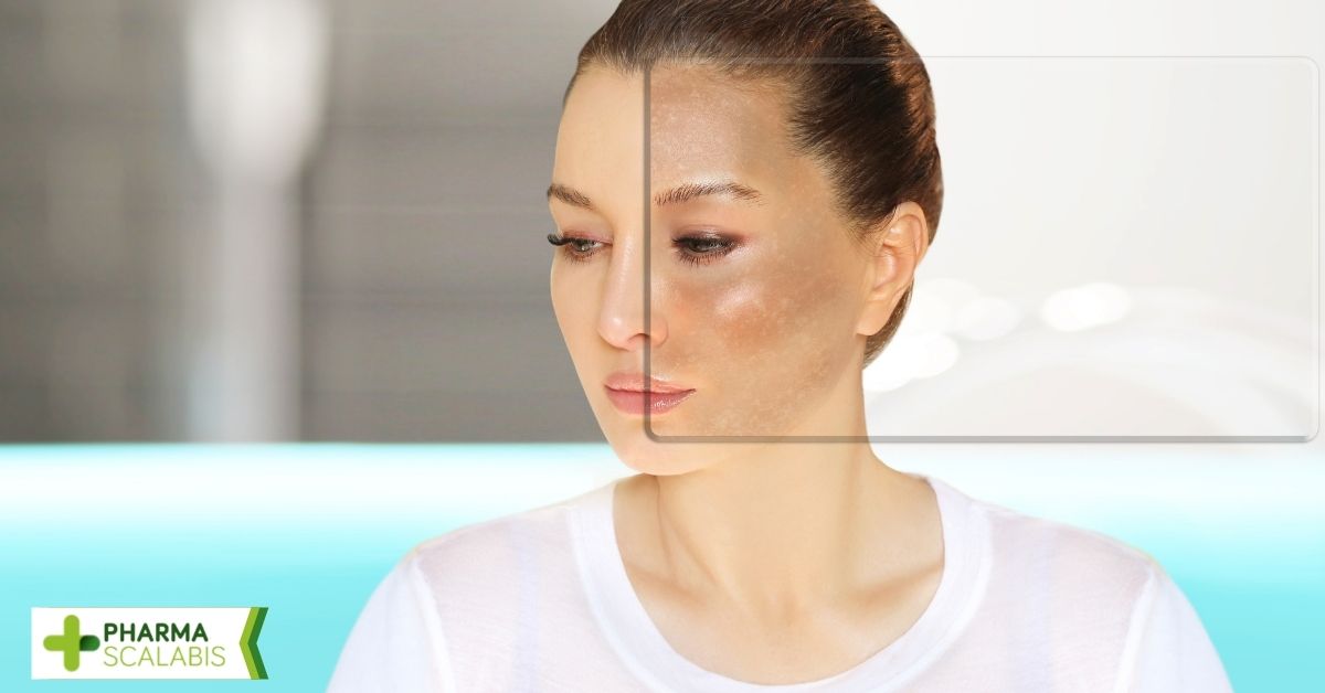Melasma, sardas, melanoma: 5 tipos de manchas que podem surgir com a exposição solar