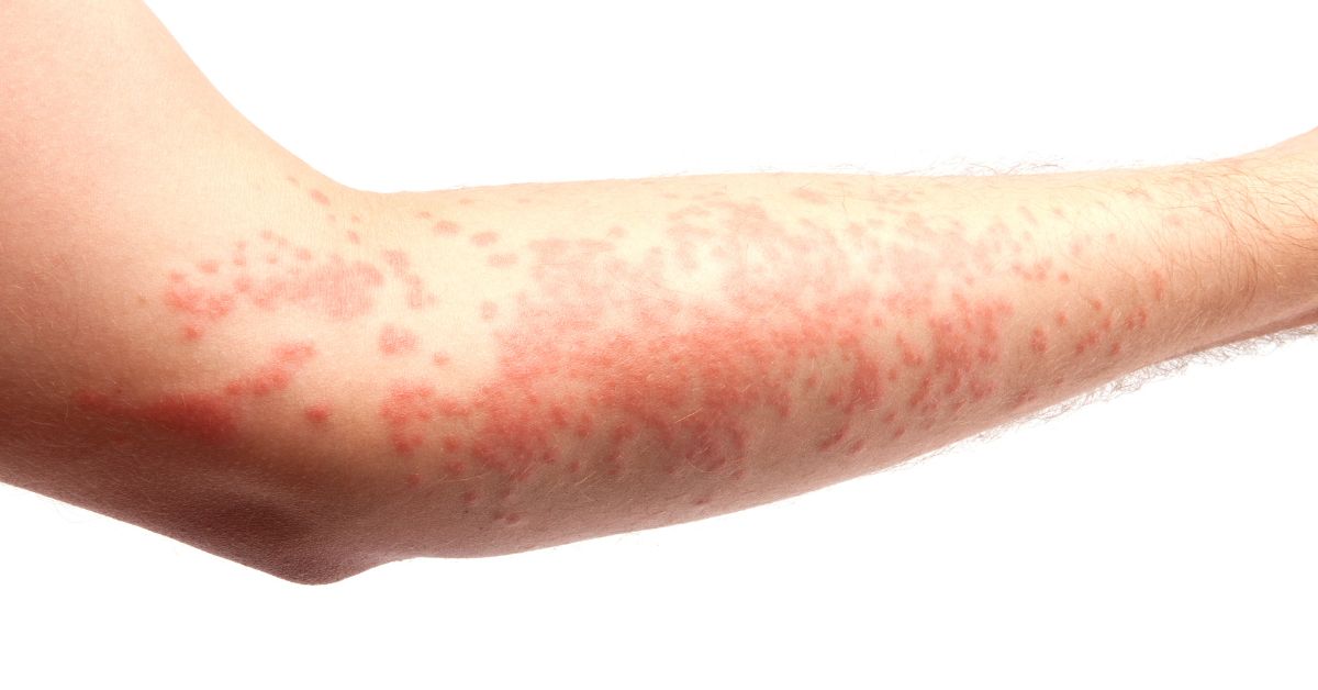 Alergia cutánea: causas, síntomas y tratamiento